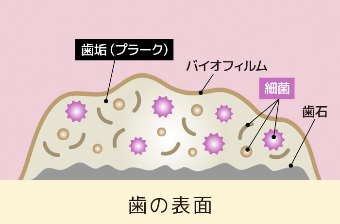 歯の表面に付着した歯垢(プラーク)・バイオフィルム・細菌・歯石の位置関係を示す断面図